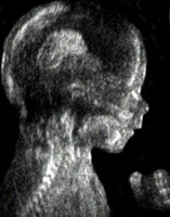 2D ultrazvuk