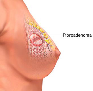 Fibroadenom