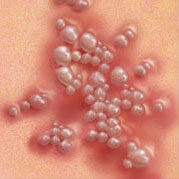 Ljeto i spolno prenosive bolest - HERPES SIMPLEX VIRUS (HSV)
