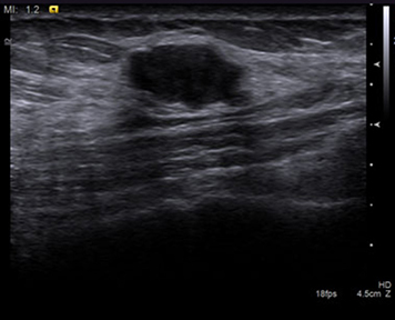 Fibroadenom ultrazvuk