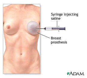 Rekonstrukcija dojke tkivnim ekspanderom